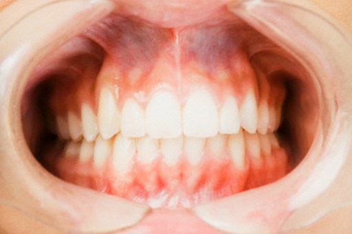 Köpek Dişin Arkasından Diş Çıkması