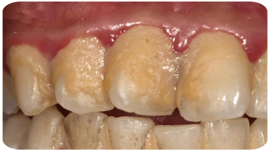 Diş Plağı - Dental Plak