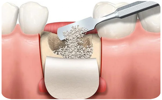 Kemik Grefti Nedir?