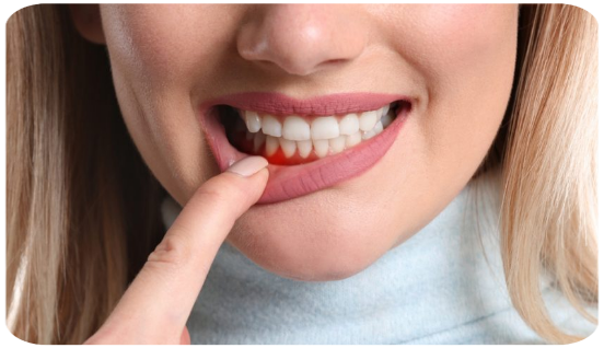 diş eti hastalıkları ankara sincan diş hekimi periodontoloji